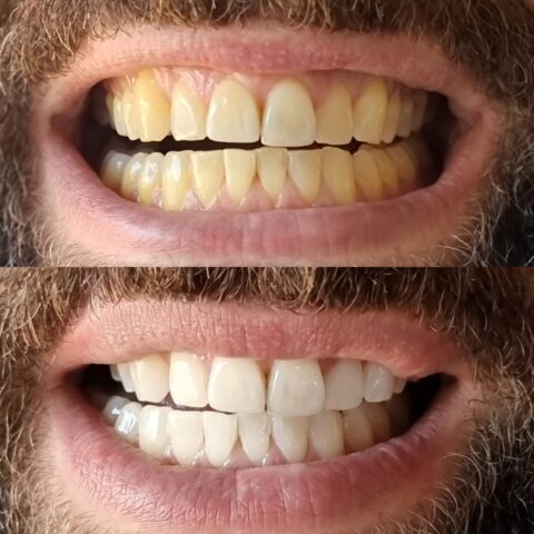 Teeth 2